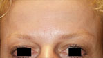 Botox Paris
