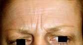 Botox Paris