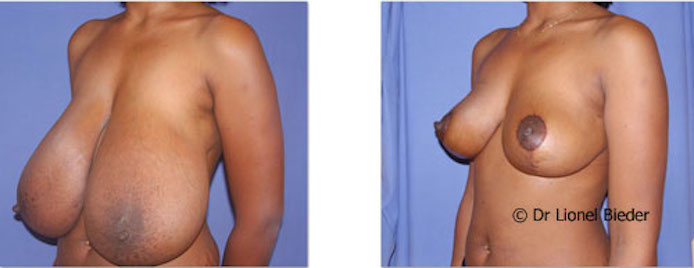 Plastie mammaire de réduction