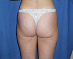Liposuccion paris