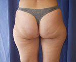 Liposuccion paris