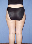 Liposuccion paris