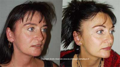 Lipofilling Martinique