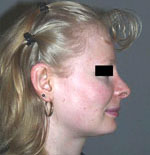 Chirurgien rhinoplastie paris