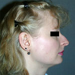 Chirurgien rhinoplastie paris