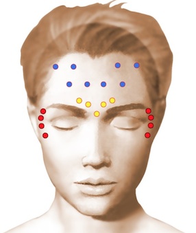 points d'injection de la toxine botulique