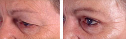 blepharoplastie superieure, photo avant-apres