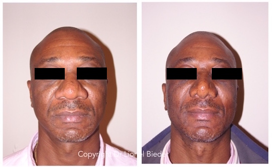 rhinoplastie ethnique, nez africain épaté