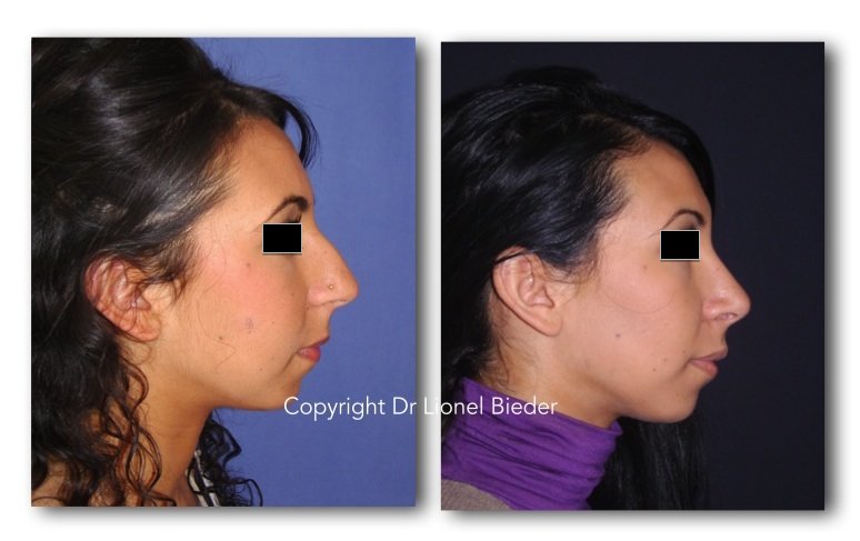 photo avant après rhinoplastie